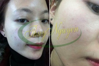 Thuốc Trị Mụn - Trị Mụn Ẩn, Mụn Cám, Đầu Đen Cho Khách Hàng TN291116